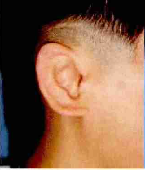 Type I Microtia