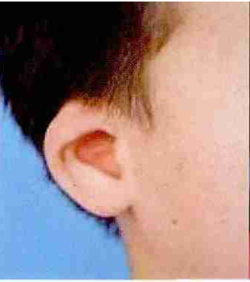 Type IIA Microtia