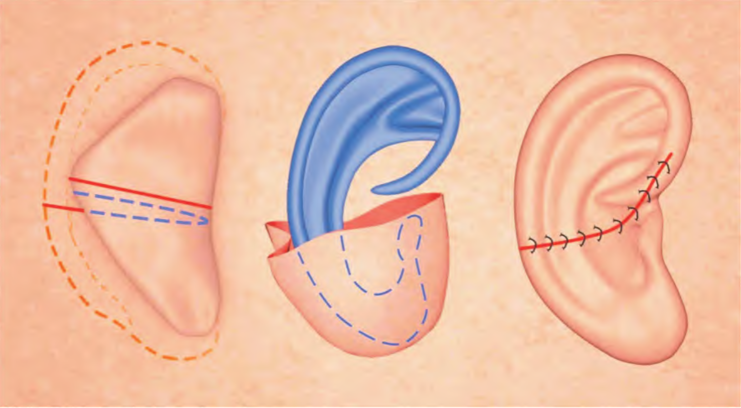 Autologous Rib Cartilage Reconstruction of Microtia: Regrowing the Ear